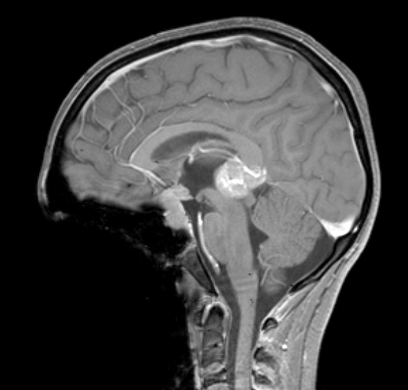 7A4 Germinoma, suprasellar & pineal (Case 7) - Copy