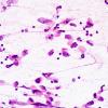 7B1 Germinoma, suprasellar & pineal (Case 7) smear H&E 2.jpg