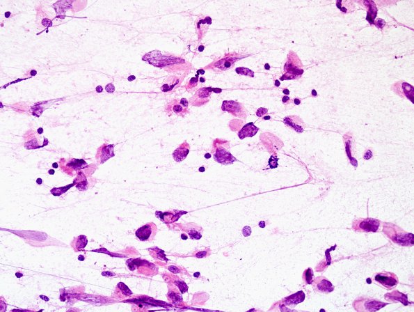 7B1 Germinoma, suprasellar & pineal (Case 7) smear H&E 2.jpg