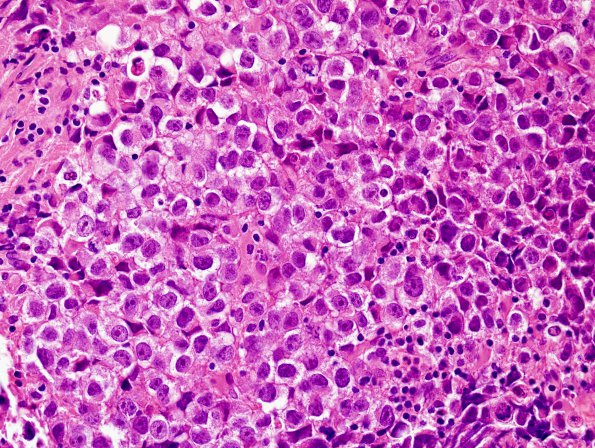 7B2 Germinoma, suprasellar & pineal (Case 7) H&E 2.jpg