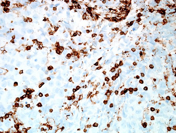 7E Germinoma, suprasellar & pineal (Case 7) CD45 LCA 4.jpg