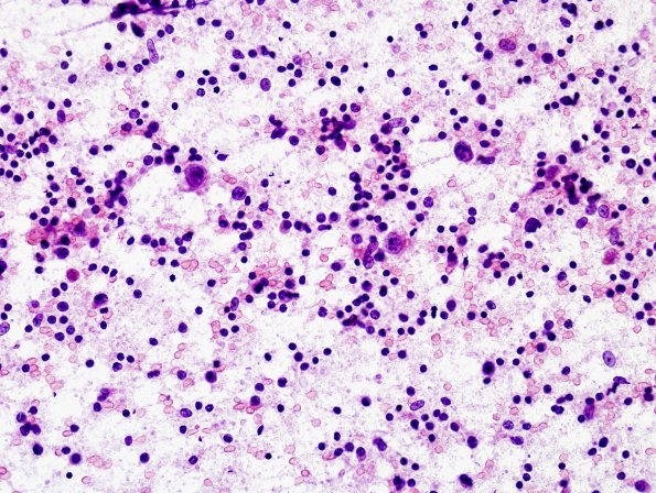 8B1 Germinoma, suprasellar (Case 8) smear 1