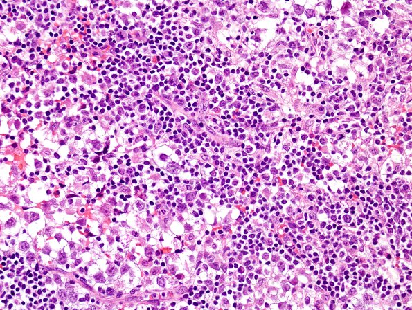 8B2 Germinoma, suprasellar (Case 8) H&E 1