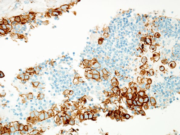 8E1 Germinoma, suprasellar (Case 8) c-Kit 3