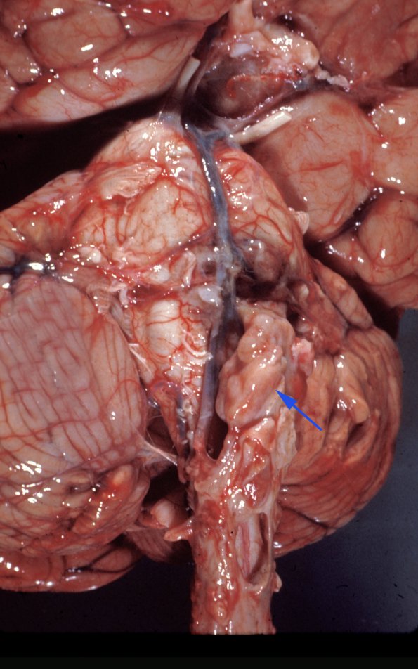 9A Germinoma & Yolk Sac (Case 9) 1 copy