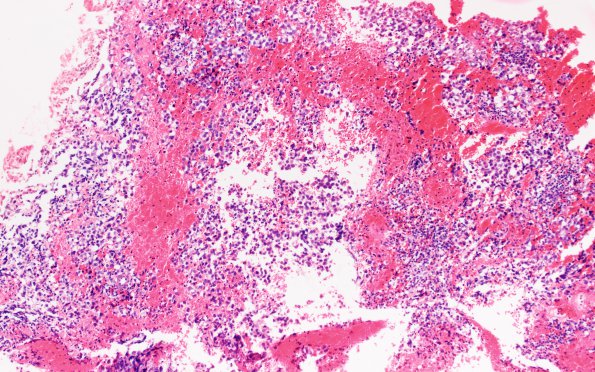 9B1 Mixed GCT (Germinoma & Yolk Sac) (Case 9) H&E 10X