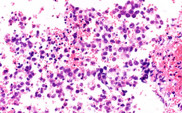 9B3 Mixed GCT (Germinoma & Yolk Sac) (Case 9) H&E 40X