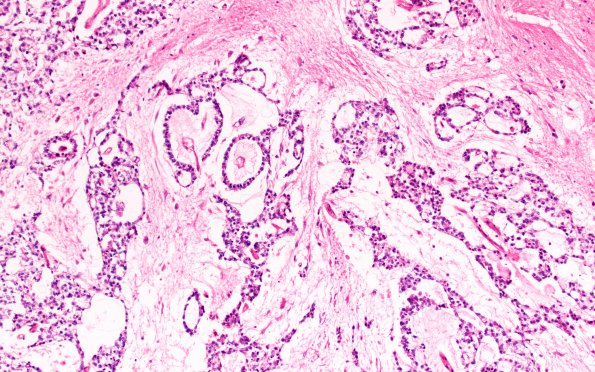 9C2 Mixed GCT (Germinoma & Yolk Sac) (Case 9) H&E 10X