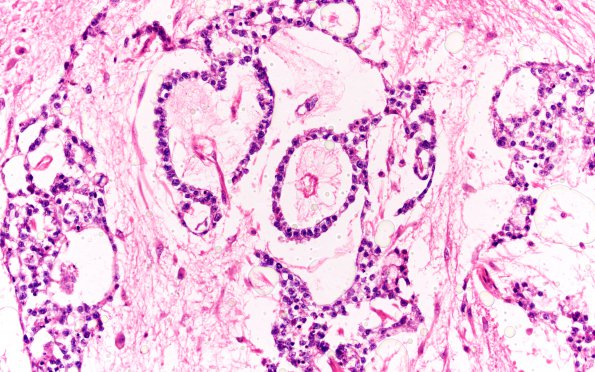 9C3 Mixed GCT (Germinoma & Yolk Sac) (Case 9) H&E 20X