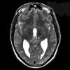 1A1 PPTID (Case 1) MRI1  Axial T2 copy