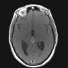 1A2 PPTID (Case 1) MRI1  Axial Contrast