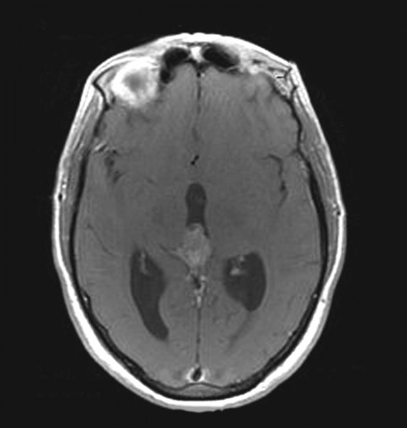 1A2 PPTID (Case 1) MRI1  Axial Contrast