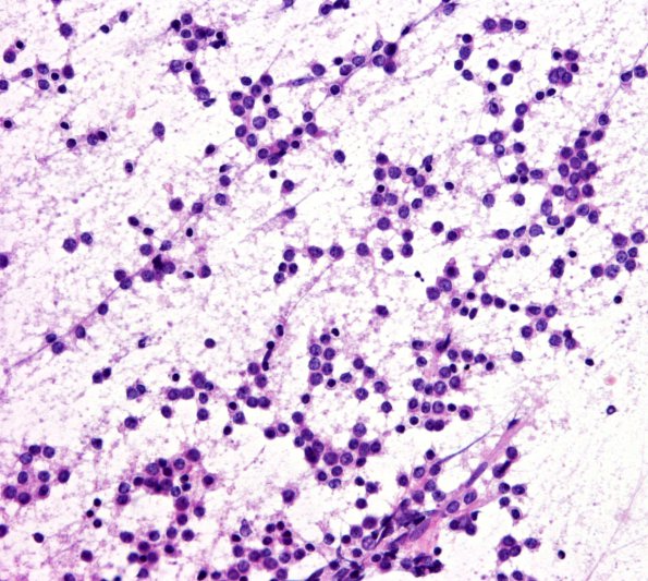 1B1 PPTID (Case 1) smear