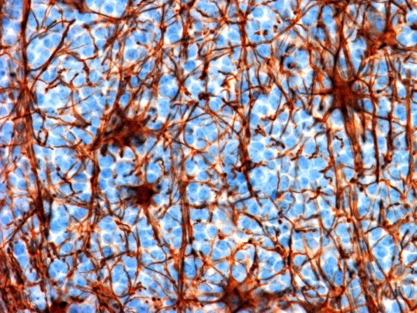 1E PPTID (Case 1) GFAP