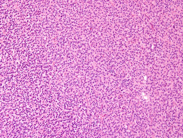 2A1 PPTID (Case 2) H&E 6.jpg