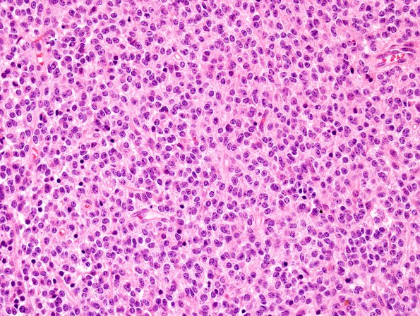 2A2 PPTID (Case 2) H&E 7.jpg