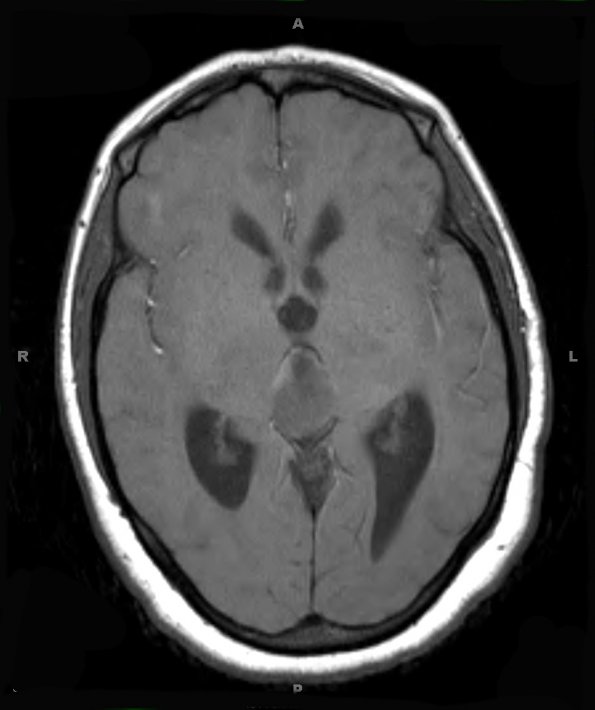 3A2 PPTID (Case 3) T1 2