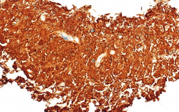 7B PPTID (Case 7) SYN 40X 1