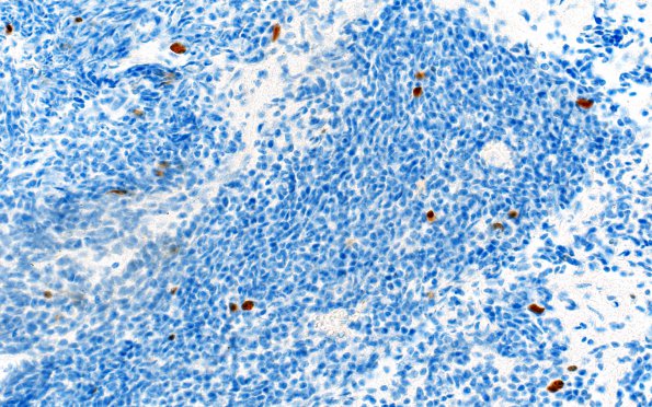 8E PPTID (Case 8) Ki67 40X 2