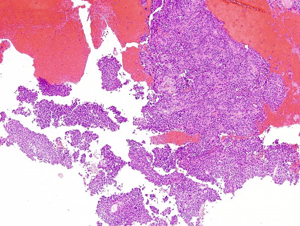 10A1 Papillary Tumor Pineal Region (Case 10) H&E 4.jpg