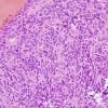 10A2 Papillary Tumor Pineal Region (Case 10) H&E 1.jpg