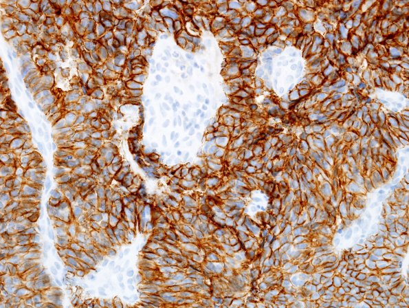 10C Papillary Tumor Pineal Region (Case 10) CD56 3.jpg