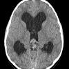 1A1 Papillary Tumor Pineal Region (PTPR, Case 1) CT A - Copy