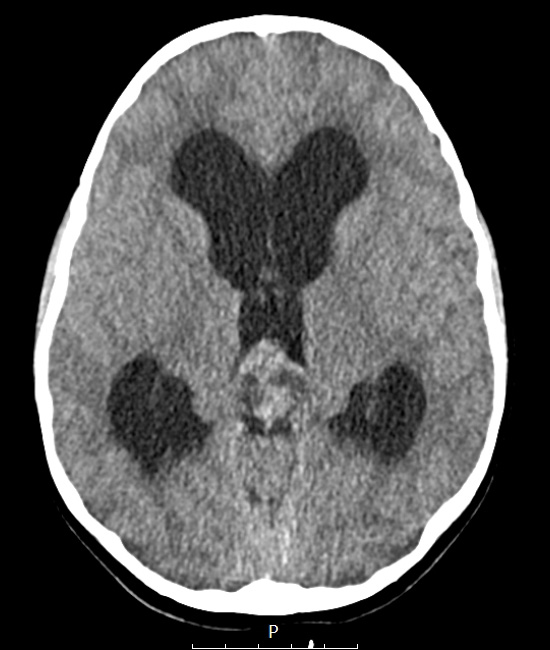 1A1 Papillary Tumor Pineal Region (PTPR, Case 1) CT A - Copy