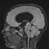 1A2 Papillary Tumor Pineal Region (PTPR, Case 1) FLAIR A - Copy