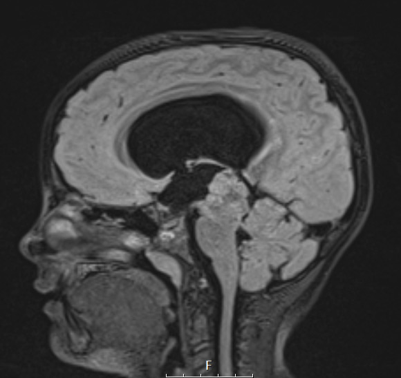 1A2 Papillary Tumor Pineal Region (PTPR, Case 1) FLAIR A - Copy