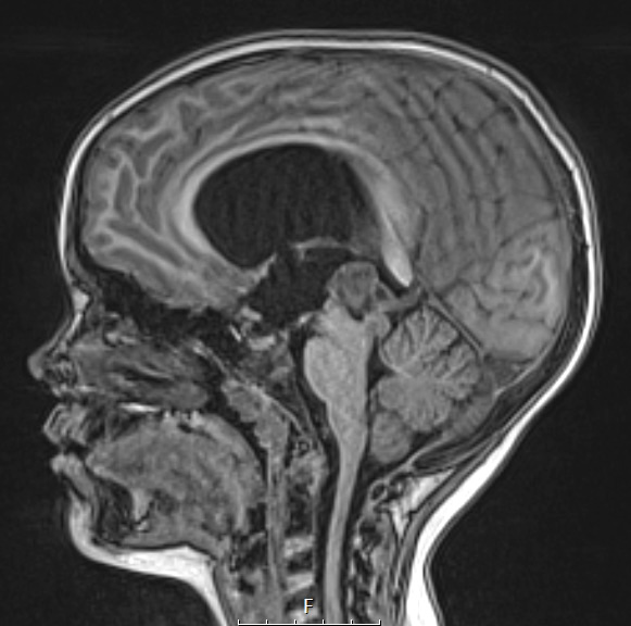 1A3 Papillary Tumor Pineal Region (PTPR, Case 1) T1noC A - Copy