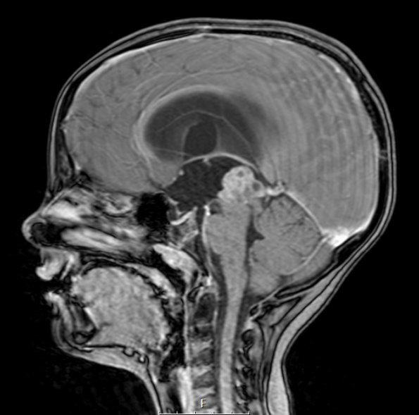 1A4 Papillary Tumor Pineal Region (PTPR, Case 1) T1W 2A - Copy