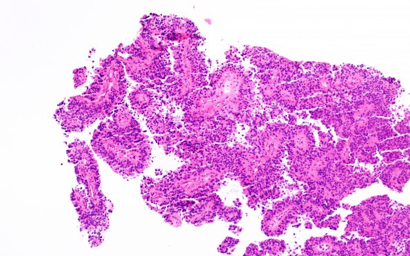 1B1 Papillary Tumor Pineal Region (PTPR, Case 1) H&E 2 10X