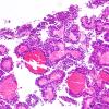 1B2 Papillary Tumor Pineal Region (PTPR, Case 1) H&E 2