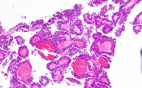 1B2 Papillary Tumor Pineal Region (PTPR, Case 1) H&E 2