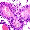 1B3 Papillary Tumor Pineal Region (PTPR, Case 1) H&E 3