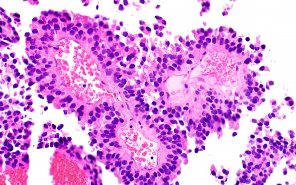 1B3 Papillary Tumor Pineal Region (PTPR, Case 1) H&E 3