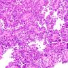 1B4 Papillary Tumor Pineal Region (PTPR, Case 1) H&E 2 20X