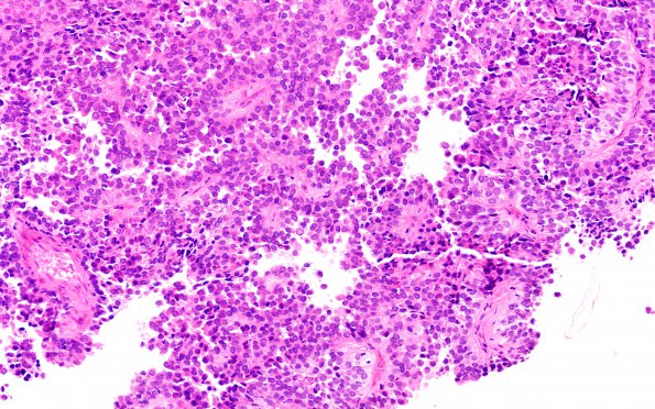 1B4 Papillary Tumor Pineal Region (PTPR, Case 1) H&E 2 20X