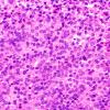 1B5 Papillary Tumor Pineal Region (PTPR, Case 1) H&E 1 40X