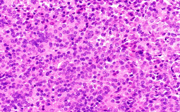 1B5 Papillary Tumor Pineal Region (PTPR, Case 1) H&E 1 40X