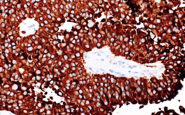 1C2 Papillary Tumor Pineal Region (PTPR, Case 1) CK8.18 1