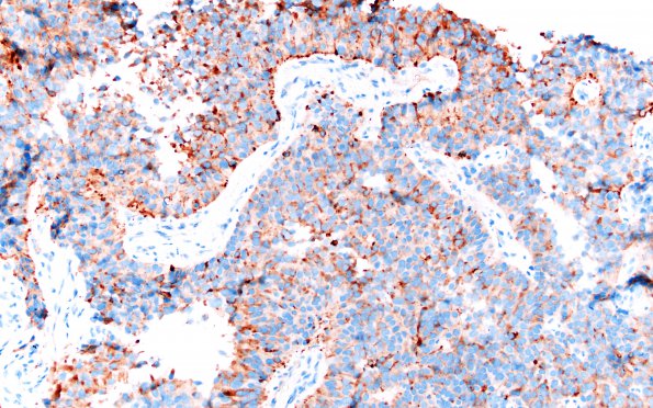 1E1 Papillary Tumor Pineal Region (PTPR, Case 1) SYNaptophysin 1