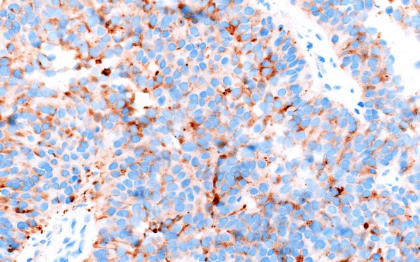 1E2 Papillary Tumor Pineal Region (PTPR, Case 1) SYNaptophysin 3