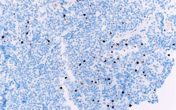 1G Papillary Tumor Pineal Region (PTPR, Case 1) Ki67