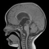 2A1 Papillary Tumor of the Pineal Region (Case 2) T1noC sag - Copy