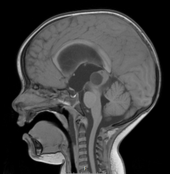 2A1 Papillary Tumor of the Pineal Region (Case 2) T1noC sag - Copy