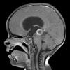 2A2 Papillary Tumor of the Pineal Region (Case 2) T1W - Copy