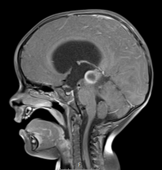 2A2 Papillary Tumor of the Pineal Region (Case 2) T1W - Copy