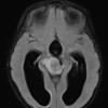 2A3 Papillary Tumor of the Pineal Region (Case 2)  FLAIR Axial - Copy